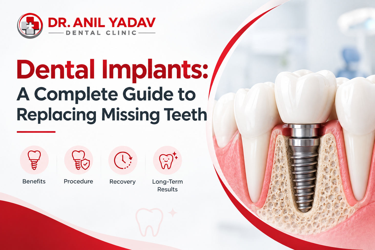 Read more about the article Dental Implants: A Complete Guide to Replacing Missing Teeth